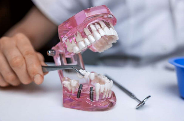 Dental Implant Bridges in Manhattan