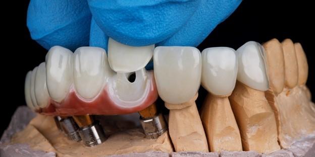 Ceramic Dental Crown Cost