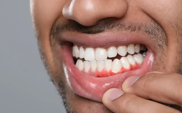 Periodontal Abscess Treatment Options for Faster Recovery