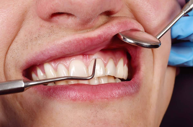 Treatment for Periodontal Abscess and Common Symptoms