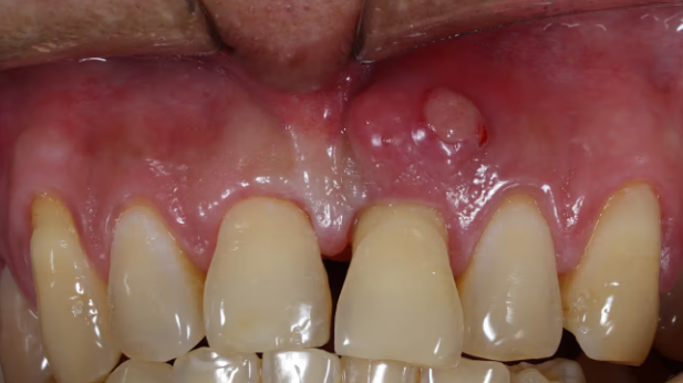 Treatment of Periodontal Abscess: Causes and Care Methods Explained