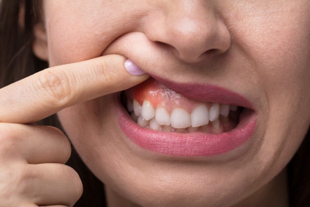 When to Seek Prompt Care for treatment periodontal abscess Concerns